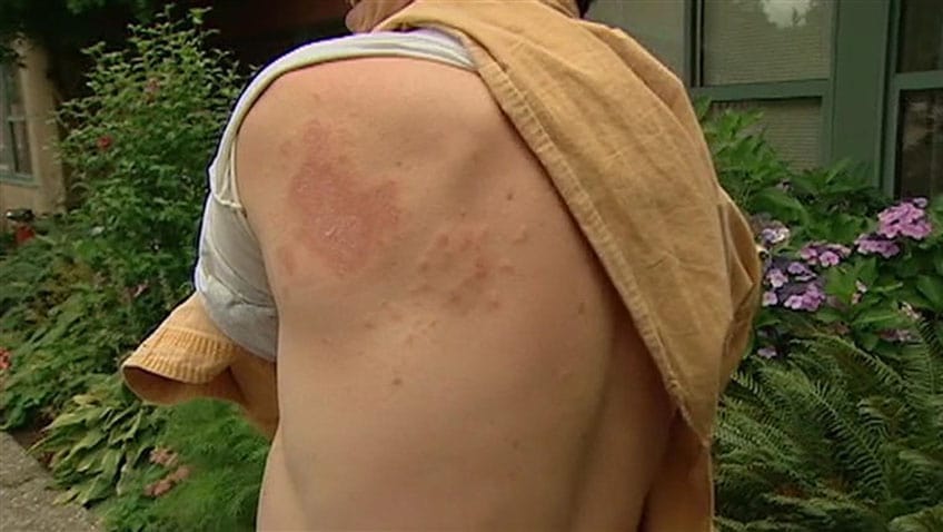 shingles virus